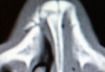 Picture : Akira Corassani’s Broken Nose